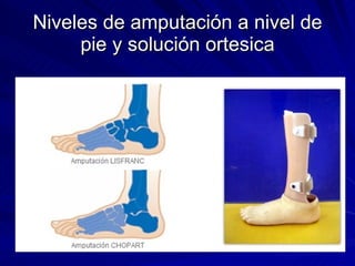Niveles de amputación a nivel de pie y solución ortesica 