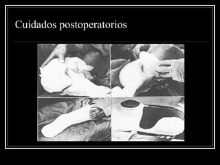 Cuidados postoperatorios 
 