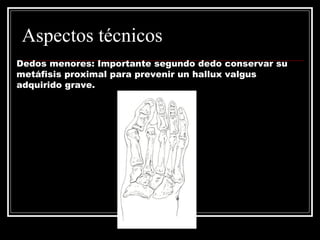 Aspectos técnicos 
Dedos menores: Importante segundo dedo conservar su 
metáfisis proximal para prevenir un hallux valgus 
adquirido grave. 
 