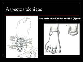 Aspectos técnicos 
Desarticulación del tobillo (Syme): 
 