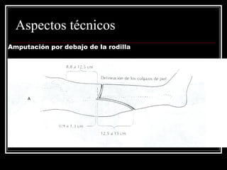 Aspectos técnicos 
Amputación por debajo de la rodilla 
 