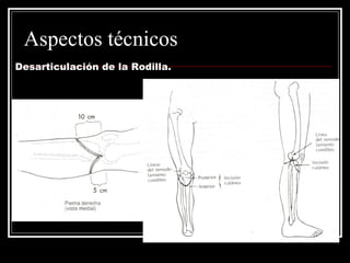 Aspectos técnicos 
Desarticulación de la Rodilla. 
