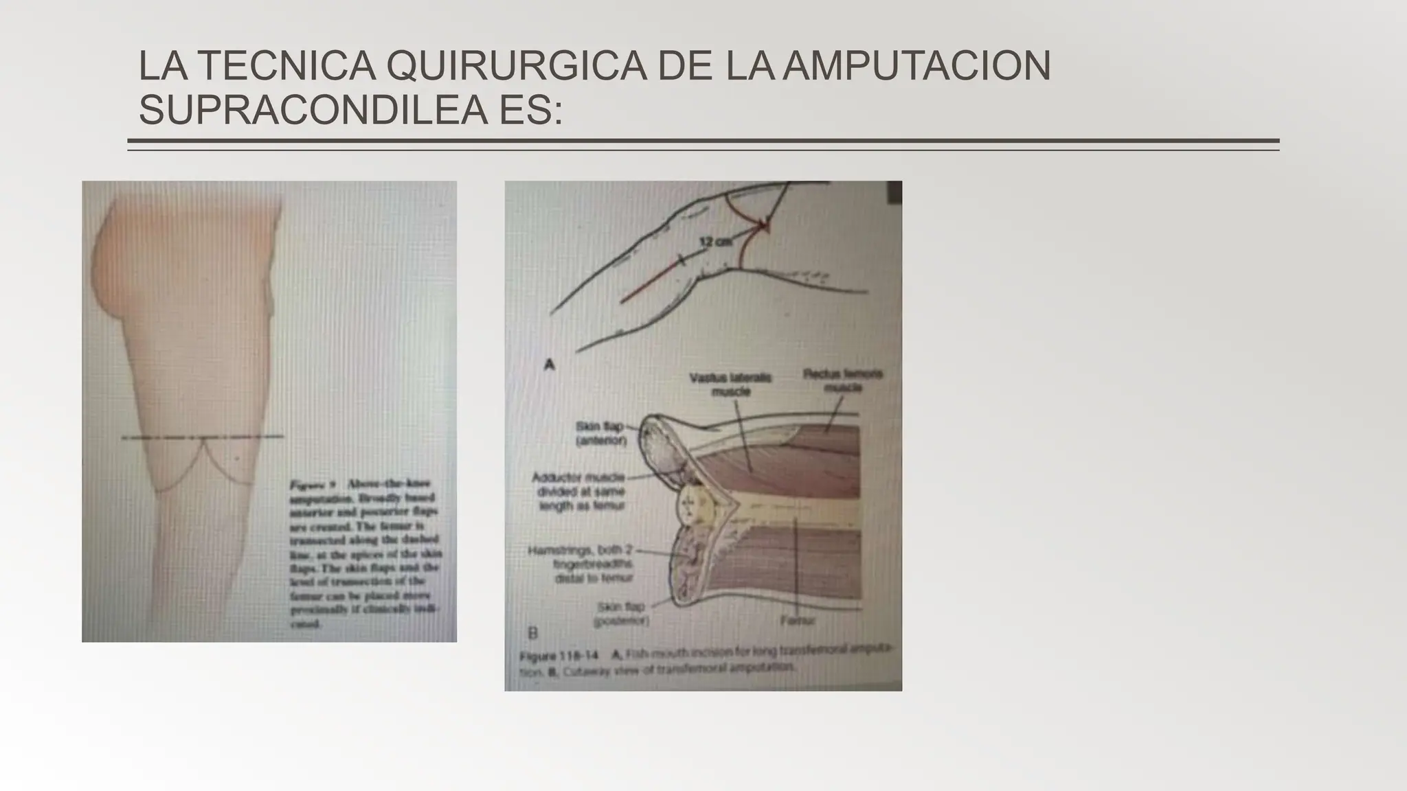 Fullerap Tecnia quirurgica de amputacion supracondileapptx | PPTX