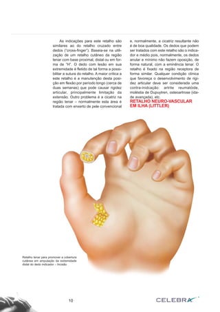 As indicações para este retalho são
similares ao do retalho cruzado entre
dedos (“cross-finger”). Baseia-se na utili-
zação de um retalho cutâneo da região
tenar com base proximal, distal ou em for-
ma de “H”. O dedo com lesão em sua
extremidade é fletido de tal forma a possi-
bilitar a sutura do retalho. A maior crítica a
este retalho é a manutenção desta posi-
ção em flexão por período longo (cerca de
duas semanas) que pode causar rigidez
articular, principalmente limitação da
extensão. Outro problema é a cicatriz na
região tenar – normalmente esta área é
tratada com enxerto de pele convencional
e, normalmente, a cicatriz resultante não
é de boa qualidade. Os dedos que podem
ser tratados com este retalho são o indica-
dor e médio pois, normalmente, os dedos
anular e mínimo não fazem oposição, de
forma natural, com a eminência tenar. O
retalho é fixado na região receptora de
forma similar. Qualquer condição clínica
que favoreça o desenvolvimento de rigi-
dez articular deve ser considerada uma
contra-inidcação: artrite reumatóide,
moléstia de Dupuytren, osteoartrose (ida-
de avançada), etc.
RETALHO NEURO-VASCULAR
EM ILHA (LITTLER)
10
Retalho tenar para promover a cobertura
cutânea em amputação da extremidade
distal do dedo indicador – Incisão
 