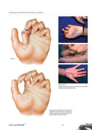 11
ATUALIZAÇÃO EM TRAUMATOLOGIA DO APARELHO LOCOMOTOR
Liberação do retalho tenar. Área doadora
tratada com enxerto de pele e retoque na
região receptora para reconstrução da
extremidade do dedo indicador.
Caso clínico:
Retalho tenar para cobertura cutânea em amputação
da extremidade distal do dedo
Sutura
 