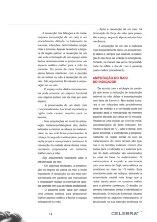 A ressecção das falanges e do meta-
carpiano (amputação de um raio) é um
procedimento utilizado no tratamento de
traumas, infecções, deformidades congê-
nitas e tumores. Apesar de reduzir a largu-
ra da região palmar, a ressecção de um
raio evita a formação de um espaço entre
dedos remanescentes e proporciona um
aspecto estético melhor para a mão do
paciente. Do ponto de vista funcional,
vários fatores interferem com a decisão
de se indicar ou não a ressecção de um
raio. São argumentos favoráveis à ampu-
tação de um raio:
• O espaço entre dedos remanescen-
tes pode provocar um prejuízo funcional
pois objetos podem cair da mão por este
espaço;
• A preservação de um dedo com
comprometimento funcional importante e
rígido pode causar prejuízo para os
demais;
• Nas amputações ao nível da articu-
lação metacarpofalangiana dos dedos
indicador e mínimo, a cabeça do metacar-
piano ou seu colo ficam proeminentes. A
cabeça do segundo metacarpiano proemi-
nente ocupa a nova primeira comissura. A
ressecção da metade distal destes meta-
carpianos proporciona um contorno
melhor para a mão.
São argumentos favoráveis para a
preservação do raio:
• Em algumas atividades, a preserva-
ção da largura da palma da mão é muito
importante. A ressecção do raio está con-
tra-indicada em paciente que manuseiam
e necessitam realizar a preensão de obje-
tos grandes em sua atividade profissional;
• O paciente pode optar por utilizar
uma prótese estética para propocionar
melhor aspecto estético e fechar o espaço
indesejável na mão;
• Após a ressecção de um raio, há
diminuição da força da mão para preen-
são e pinça, segundo alguns estudos bio-
mecânicos.
A amputação de um raio é realizada
mais freqüentemente como um procedimen-
to eletivo e, sempre que possível, a ressec-
ção do raio deve ser evitada na emergência.
Portanto, na maioria das vezes, há possibili-
dade de refletir e discutir com o paciente
qual o melhor procedimento.
AMPUTAÇÃO DO RAIO
DO INDICADOR
De acordo com a etiologia da patolo-
gia que levou a indicação de amputação
pode-se ou não utilizar a exsanguinação
com faixa de Esmarch. Nas lesões tumo-
rais e em infecções este procedimento
deve ser evitado e o torniquete pode ser
aplicado após a manutenção do membro
superior elevado por cerca de 10 minutos.
Realiza-se uma incisão ao nível da meta-
carpofalangiana do dedo indicador, for-
mando a figura de “V”, volar e dorsal, com
ápice proximal, e estendendo-a longitudi-
nalmente na região dorsal no eixo do
metacarpiano. As veias dorsais são liga-
das e os tendões extensor comum dos
dedos para o indicador e o extensor pró-
prio do dedo indicador são seccionados
ao nível da base do metacarpiano. O
metacarpiano é exposto e seccionado
com uma serra de Gigli, serra elétrica ou
osteótomo ao nível do 1/3 médio. Esta
osteotomia pode ser oblíqua, deixando a
extremidade medial mais longa que a
radial, dando assim um contorno melhor
para a primeira comissura. O tendão do
primeiro interósseo dorsal é identificado e
seccionado. O músculo lumbrical, situado
redialmente ao segundo metacarpiano, é
seccionado na sua inserção tendinosa no
14
 