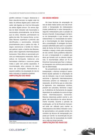 parelho extensor. À seguir, disseca-se o
feixe vásculo-nervoso na região volar do
dedo. As artérias digitais para o dedo indi-
cador são ligadas ao nível da bifurcação
da artéria digital comum. Os nervos digi-
tais do dedo indicador são tracionados e
seccionados proximalmente, de tal forma
que os cotos, retraindo, permanecem na
palma da mão. Da mesma forma, os ten-
dões flexores superficial e profundo são
identificados e seccionados, retraindo
proximalmente para a palma da mão. À
seguir, secciona-se o tendão do interós-
seo palmar e após, a bainha dos flexores,
placa volar e ligamento intermetacarpiano
transverso. Este último é seccionado pró-
ximo ao metacarpiano ressecado. Após a
soltura do torniquete, realiza-se uma
hemostasia criteriosa e sutura-se partes
moles e pele com pontos separados. A
movimentação ativa precoce do dedo
deve ser encorajada. Normalmente o
aspecto estético da amputação do raio do
dedo indicador é bastante aceitável.
AMPUTAÇÃO DO RAIO
DO DEDO MÉDIO
Há duas técnicas de amputação do
raio do dedo médio sendo uma não envol-
vendo a transposição de metacarpiano
(nossa preferência) e outra transpondo o
segundo metacarpiano para a posição do
terceiro (Carroll). A desvantagem da técni-
ca da transposição é que envolve uma
osteossíntese e a necessidade de restrin-
gir a movimentação do dedo transposto
até a consolidação. A vantagem da trans-
posição salientada pelo autor é a possibili-
dade de fechar de forma mais eficiente e
imediata o espaço criado pela amputação
de raio central. Outro problema relaciona-
do com a transposição é o cuidado que
deve ser tomado com os desvios rotacio-
nais. É recomendado utilizar um fio de
Kirschner transversal para fixar o metacar-
po transposto nos vizinhos para evitar este
tipo de deformidade.
No procedimento de amputação sem
transposição, a técnica cirúrgica é seme-
lhante àquela aplicada na amputação do
raio do indicador, mas é muito importante
seccionar o ligamento intermetacarpiano
transverso próximo ao metacarpo a ser
ressecado, de tal forma que os cotos des-
te ligamento, dos metacarpos vizinhos,
possam ser suturados, fechando o espa-
ço. A eficiência do fechamento do espaço
dependerá da qualidade da sutura do liga-
mento intermetacarpiano transverso.
Desvios rotacionais podem ocorrer e, em
geral, são decorrência de sutura técnica-
mente incorreta. Durante o período de
cicatrização, um fio de Kirschner transver-
sal pode ser utilizado para manter os
metacarpianos dos dedos indicador e anu-
lar aproximados e em posição correta. Ao
contrário da técnica de transposição pro-
posta por Carroll, na reconstrução de par-
tes moles não há necessidade de imobili-
zar a mão por longo período.
AMPUTAÇÃO DO RAIO DO
15
ATUALIZAÇÃO EM TRAUMATOLOGIA DO APARELHO LOCOMOTOR
Caso clínico:
Amputação transmetacarpiana do dedo indicador
 