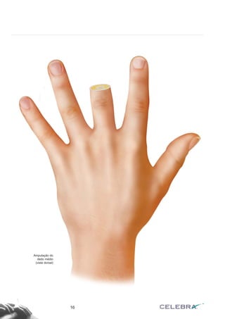 16
Amputação do
dedo médio
(vista dorsal)
 