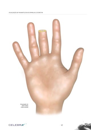 17
ATUALIZAÇÃO EM TRAUMATOLOGIA DO APARELHO LOCOMOTOR
Amputação do
dedo médio
(vista central)
 
