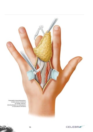 18
Amputação transmetacarpiana,
incisão dorsal e tenotomia
do tendão extensor,
individualização do metacarpiano
e musculatura intrínseca
 