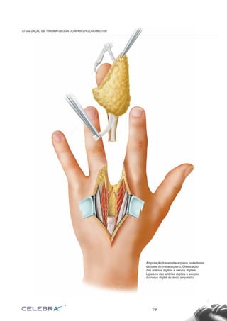 19
ATUALIZAÇÃO EM TRAUMATOLOGIA DO APARELHO LOCOMOTOR
Amputação transmetacarpiana, osteotomia
da base do metacarpiano. Dissecação
das artérias digitais e nervos digitais.
Ligadura das artérias digitais e secção
do nervo digital do dedo amputado
 