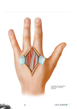 20
Amputação transmetacarpiana:
aspecto final – sutura dos
intrínsecos
 