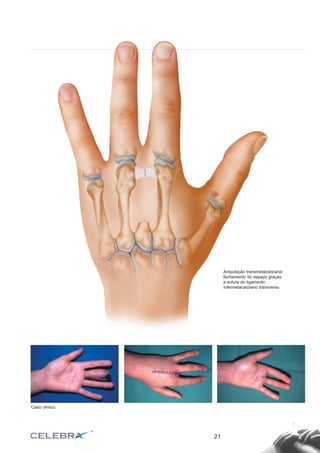 21
Caso clínico:
Amputação transmetacarpiana:
fechamento do espaço graças
a sutura do ligamento
intermetacarpiano transverso
 
