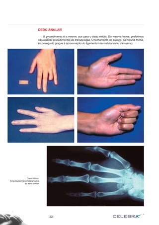 DEDO ANULAR
O procedimento é o mesmo que para o dedo médio. Da mesma forma, preferimos
não realizar procedimentos de transposição. O fechamento do espaço, da mesma forma,
é conseguido graças à aproximação do ligamento intermatatarsiano transverso.
22
Caso clínico:
Amputação transmetacarpiana
do dedo anular
 