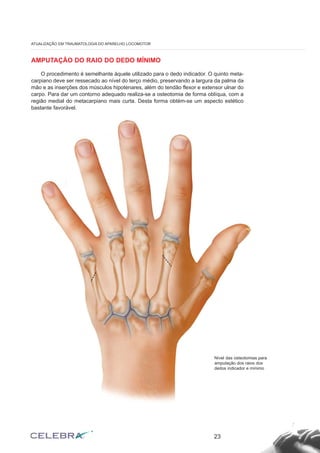 AMPUTAÇÃO DO RAIO DO DEDO MÍNIMO
O procedimento é semelhante àquele utilizado para o dedo indicador. O quinto meta-
carpiano deve ser ressecado ao nível do terço médio, preservando a largura da palma da
mão e as inserções dos músculos hipotenares, além do tendão flexor e extensor ulnar do
carpo. Para dar um contorno adequado realiza-se a osteotomia de forma oblíqua, com a
região medial do metacarpiano mais curta. Desta forma obtém-se um aspecto estético
bastante favorável.
23
ATUALIZAÇÃO EM TRAUMATOLOGIA DO APARELHO LOCOMOTOR
Nível das osteotomias para
amputação dos raios dos
dedos indicador e mínimo
 