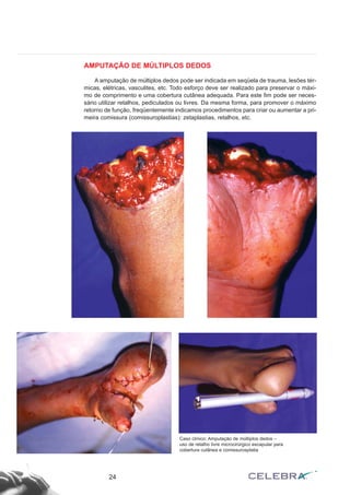 AMPUTAÇÃO DE MÚLTIPLOS DEDOS
A amputação de múltiplos dedos pode ser indicada em seqüela de trauma, lesões tér-
micas, elétricas, vasculites, etc. Todo esforço deve ser realizado para preservar o máxi-
mo de comprimento e uma cobertura cutânea adequada. Para este fim pode ser neces-
sário utilizar retalhos, pediculados ou livres. Da mesma forma, para promover o máximo
retorno de função, freqüentemente indicamos procedimentos para criar ou aumentar a pri-
meira comissura (comissuroplastias): zetaplastias, retalhos, etc.
24
Caso clínico: Amputação de múltiplos dedos –
uso de retalho livre microcirúrgico escapular para
cobertura cutânea e comissurosplatia
 
