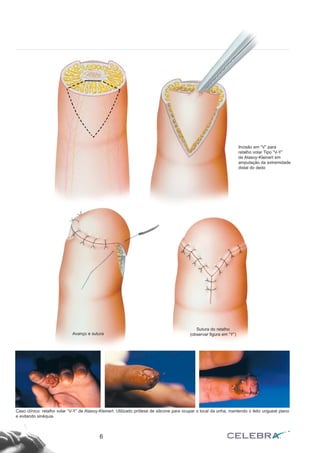 6
Incisão em “V” para
retalho volar Tipo “V-Y”
de Atasoy-Kleinert em
amputação da extremidade
distal do dedo
Avanço e sutura
Sutura do retalho
(observar figura em “Y”)
Caso clínico: retalho volar “V-Y” de Atasoy-Kleinert. Utilizado prótese de silicone para ocupar o local da unha, mantendo o leito ungueal plano
e evitando sinéquia.
 
