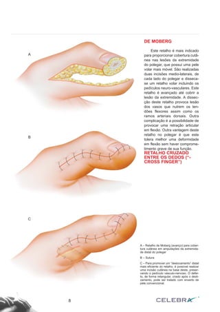 DE MOBERG
Este retalho é mais indicado
para proporcionar cobertura cutâ-
nea nas lesões da extremidade
do polegar, que possui uma pele
volar mais móvel. São realizadas
duas incisões medio-laterais, de
cada lado do polegar e disseca-
se um retalho volar incluindo os
pedículos neuro-vasculares. Este
retalho é avançado até cobrir a
lesão da extremidade. A dissec-
ção deste retalho provoca lesão
dos vasos que nutrem os ten-
dões flexores assim como os
ramos arteriais dorsais. Outra
complicação é a possibilidade de
provocar uma retração articular
em flexão. Outra vantagem deste
retalho no polegar é que este
tolera melhor uma deformidade
em flexão sem haver comprome-
timento grave de sua função.
RETALHO CRUZADO
ENTRE OS DEDOS (“-
CROSS FINGER”)
8
A
B
C
A – Retalho de Moberg (avanço) para cober-
tura cutânea em amputações da extremida-
de distal do polegar
B – Sutura
C – Para promover um “deslocamento” distal
mais eficiente do retalho, é possível realizar
uma incisão cutânea na base deste, preser-
vando o pedículo vásculo-nervoso. O defei-
to, de forma retangular, criado após o desli-
zamento, pode ser tratado com enxerto de
pele convencional.
 