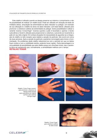 Este retalho é utilizado quando se deseja preservar ao máximo o comprimento e não
há possibilidade de realizar um retalho local. Pode ser utilizado em situação de lesão de
múltiplos dedos, amputação da extremidade do dedo indicador ou polegar. Um exemplo
de sua utilização é o retalho do dorso do dedo indicador, com base lateral, utilizado para
promover a cobertura cutânea da extremidade do polegar. Outra possibilidade é utilizar a
variante reversa (“cross-finger” reverso) quando a pele é levantada e apenas o tecido
subcutâneo e facial é utilizado para proporcionar a cobertura, suturando-se novamente a
pele em seu leito original. Em ambas situações há necessidade de aguardar-se a integra-
ção do retalho no leito receptor para realizar a secção do pedículo. Isto ocorre em cerca
de duas semanas. Após a secção do pedículo o paciente é encorajado para iniciar a movi-
mentação. Os problemas deste retalho relacionam-se com o período em que os dedos
ficam unidos e com a mobilidade restrita, podendo haver rigidez. Outra desvantagem é a
má qualidade da sensibilidade que este retalho possui em uma fase inicial, mas o pacien-
te deve ser esclarecido que, normalmente, a sensibilidade melhora com o tempo.
RETALHO TENAR
9
ATUALIZAÇÃO EM TRAUMATOLOGIA DO APARELHO LOCOMOTOR
Retalho “Cross Finger reverso”
para promover a cobertura da
falange distal exposta
após queimadura por agente
químico para queimar
“verruga vulgar”
Retalho “Cross Finger”
para cobertura cutânea
do dedo anular
 