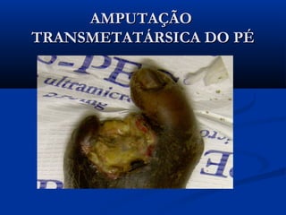 AMPUTAÇÃO
TRANSMETATÁRSICA DO PÉ

 