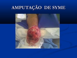AMPUTAÇÃO DE SYME

 