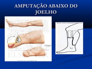 AMPUTAÇÃO ABAIXO DO
JOELHO

 