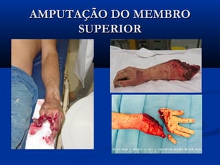 AMPUTAÇÃO DO MEMBRO
SUPERIOR

 