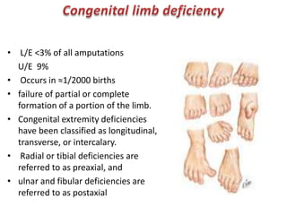Congenital limb deficiency L/E <3% of all amputations     U/E  9% Occurs in ≈1/2000 birthsfailure of partial or complete formation of a portion of the limb. Congenital extremity deficiencies have been classified as longitudinal, transverse, or intercalary. Radial or tibial deficiencies are referred to as preaxial, and ulnar and fibular deficiencies are referred to as postaxial 