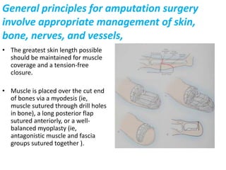Muscle is placed over the cut end of bones via a myodesis (ie, muscle sutured through drill holes in bone), a long posterior flap sutured anteriorly, or a well-balanced myoplasty (ie, antagonistic muscle and fascia groups sutured together ).Nerves are transected under tension, proximal to the cut end of bones in a scar- and tension-free environment. Ligation of large nerves can be performed when an associated vessel is present. The larger arteries and veins are dissected and separately ligated. This prevents the development of arteriovenous fistulas and aneurysms. Bony prominences around disarticulations are removed with a saw and filed smooth. Diaphysealtransections can be covered with a local flexible osteoperiosteal graft. Maintaining the maximal extremity length possible is desirable. However, below-knee amputations are best performed 12.5-17.5 cm below the joint line for nonischemic limbs One application guide is to make a limb 2.5 cm long for every 30 cm of body height for upper limb. For ischemic limbs, a higher level of 10-12.5 cm below the joint line is used because making limbs longer than this can interfere with prosthetic use and design 