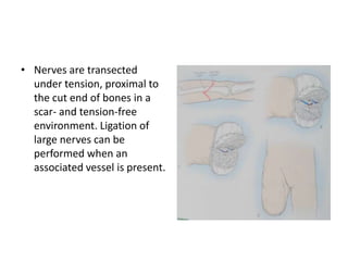 Preserve the physis. Amputations through the metaphysis (such as above-knee or distal forearm level) or diaphysis are not recommended in children because of the progressive relative shortening of the residual limb. This is most critical in the femur, but it is applicable to other long bones as well. Disarticulate when possible. Disarticulation completely eliminates the problem of terminal overgrowth and subsequent revision surgery. Standard surgical principles for amputation in the child 