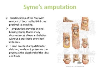 Larrey’s amputation;-   amputation at the shoulder joint. spontaneous amputation;-   loss of a part without surgical intervention, as in diabetes mellitusSarmiento’s amputation- level is 1.3 cms proximal to ankle joint line. 