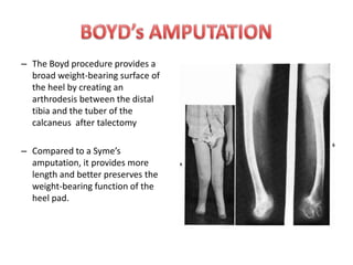 Teale’s amputation;-   amputation with short and long rectangular flaps. Syme’s amputation disarticulation of the foot with removal of both malleoli 0.6 cms proximal to joint line.