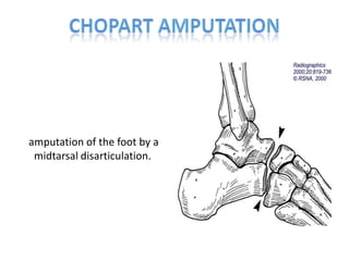    amputation provides an end-bearing stump that in many circumstances allows ambulation without a prosthesis over short distances. 