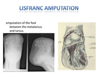  It is an excellent amputation for children, in whom it preserves the physes at the distal end of the tibia and fibulaBOYD’s AMPUTATIONThe Boyd procedure provides a broad weight-bearing surface of the heel by creating an arthrodesis between the distal tibia and the tuber of the calcaneus  after talectomyCompared to a Syme’s amputation, it provides more length and better preserves the weight-bearing function of the heel pad.