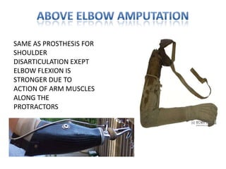 PROSTHESIS FOR UPPER LIMB AMPUTATIONSFOREQUARTER AMPUTATIONS-        -PROSTHESIS MERELY SERVES A COSMETIC                 PURPOSE    -SLEEVE FITTER PROSTHESIS WITH A PLASTOZOATE CAP PADDED INSIDE WITH FOAM AND RETAINING STRAPS IS USEDMyoelectric Prosthetics