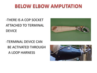 SHOULDER PIECE EXTENDED CAP TO HOLD PROSTHESIS