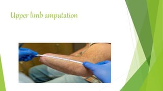 Upper limb amputation
 