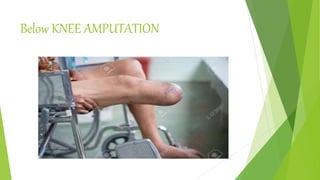 Below KNEE AMPUTATION
 