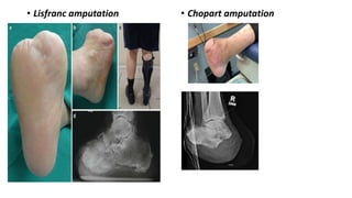 • Lisfranc amputation • Chopart amputation
 