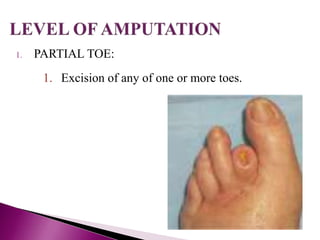 Racket Incision Toe AMPUTATION ppt By Dr. Mumux | PPTX