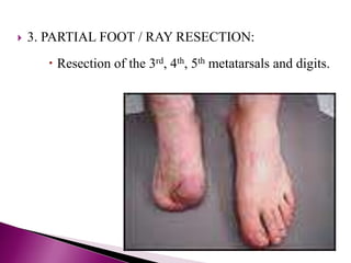  3. PARTIAL FOOT / RAY RESECTION:
 Resection of the 3rd, 4th, 5th metatarsals and digits.
 