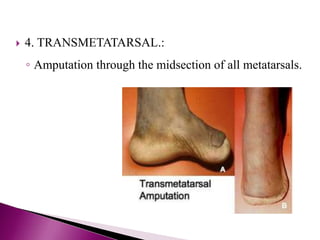  4. TRANSMETATARSAL.:
◦ Amputation through the midsection of all metatarsals.
 