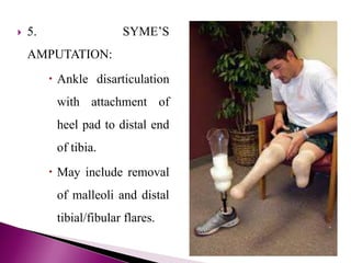  5. SYME’S
AMPUTATION:
 Ankle disarticulation
with attachment of
heel pad to distal end
of tibia.
 May include removal
of malleoli and distal
tibial/fibular flares.
 