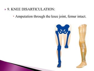  9. KNEE DISARTICULATION:
 Amputation through the knee joint, femur intact.
 