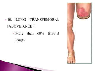  10. LONG TRANSFEMORAL
[ABOVE KNEE]:
 More than 60% femoral
length.
 