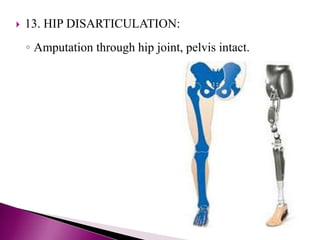  13. HIP DISARTICULATION:
◦ Amputation through hip joint, pelvis intact.
 