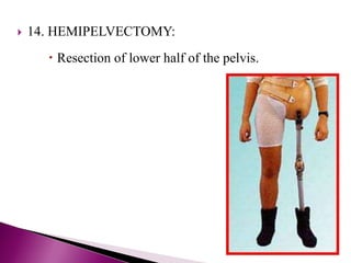  14. HEMIPELVECTOMY:
 Resection of lower half of the pelvis.
 