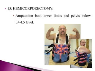  15. HEMICORPORECTOMY:
 Amputation both lower limbs and pelvis below
L4-L5 level.
 