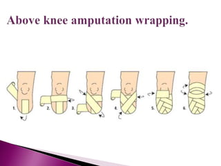 AMPUTATION ppt By Dr. Mumux | PPTX