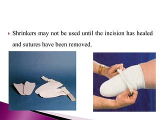  Shrinkers may not be used until the incision has healed
and sutures have been removed.
 